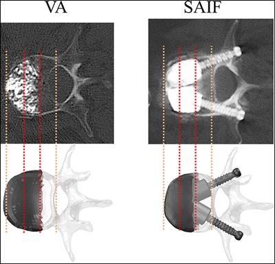 Stent-Screw Assisted Internal Fixation of Osteoporotic Vertebrae: A Comparative Finite Element Analysis on SAIF Technique